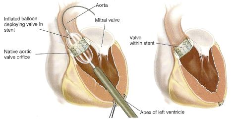 Bio-prothèse de troisième génération