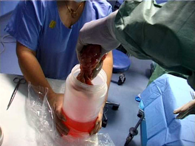 Transplantation d’un rein à l’hôpital Henri Mondor à Créteil