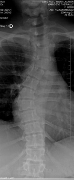 Scoliose double sévère avancée